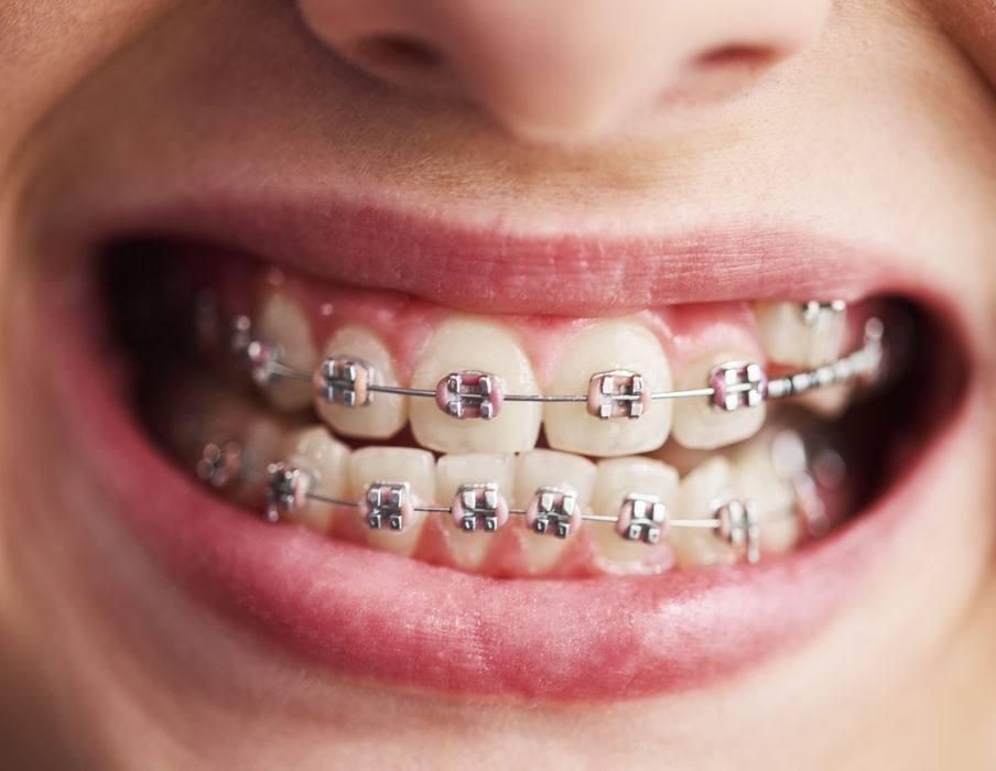 logopedia-fogszabalyzo